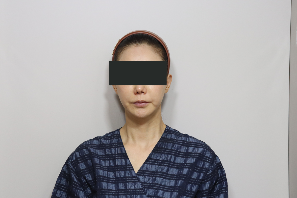 Facelift and neck lift with combined skin treatments at Good-Line Plastic Surgery. Before combined treatment, frontal — Good-Line Plastic Surgery case 01. Cheeks, lower-face outline and neck are visible. Eyes are covered for privacy.