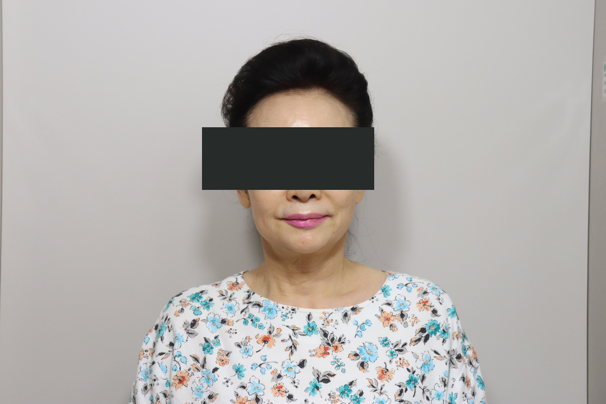 Eyelid surgery with facelift and neck lift at Good-Line Plastic Surgery. After combined treatment, frontal — Good-Line Plastic Surgery case 02. Cheeks, lower-face outline and neck are visible. Eyes are covered for privacy.