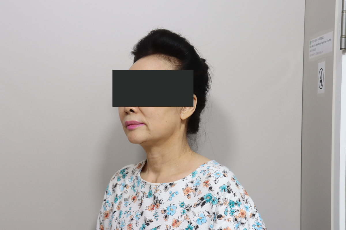 Eyelid surgery with facelift and neck lift at Good-Line Plastic Surgery. After combined treatment, oblique view facing left — Good-Line Plastic Surgery case 02. The angle shows the jawline and the contour beneath the chin. Eyes are covered for privacy.