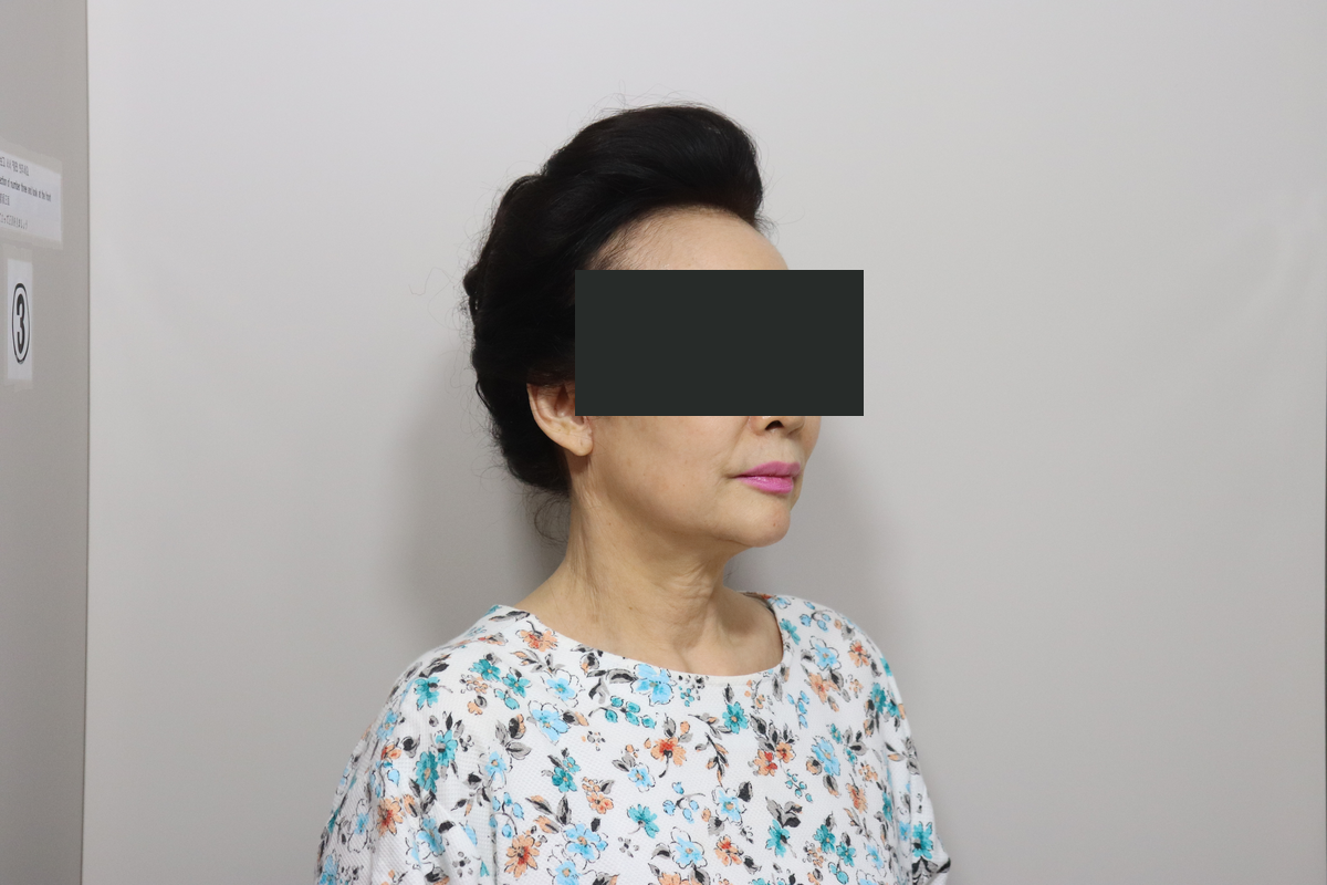 Eyelid surgery with facelift and neck lift at Good-Line Plastic Surgery. After combined treatment, oblique view facing right — Good-Line Plastic Surgery case 02. The angle shows the jawline and the contour beneath the chin. Eyes are covered for privacy.