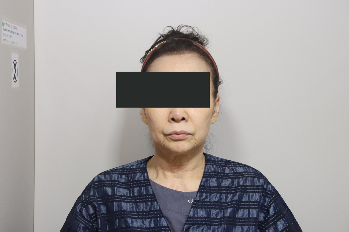Eyelid surgery with facelift and neck lift at Good-Line Plastic Surgery. Before combined treatment, frontal — Good-Line Plastic Surgery case 02. Cheeks, lower-face outline and neck are visible. Eyes are covered for privacy.