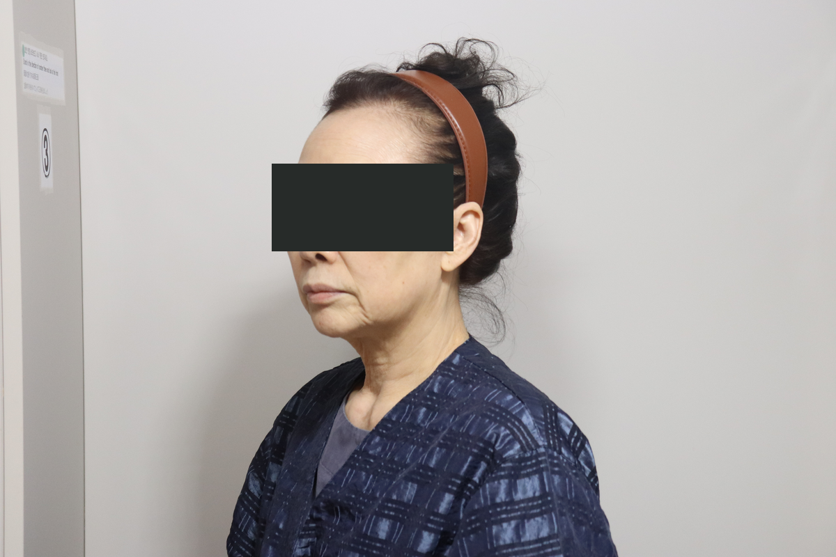 Eyelid surgery with facelift and neck lift at Good-Line Plastic Surgery. Before combined treatment, oblique view facing left — Good-Line Plastic Surgery case 02. The angle shows the jawline and the contour beneath the chin. Eyes are covered for privacy.