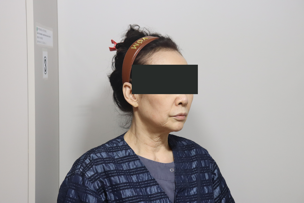 Eyelid surgery with facelift and neck lift at Good-Line Plastic Surgery. Before combined treatment, oblique view facing right — Good-Line Plastic Surgery case 02. The angle shows the jawline and the contour beneath the chin. Eyes are covered for privacy.