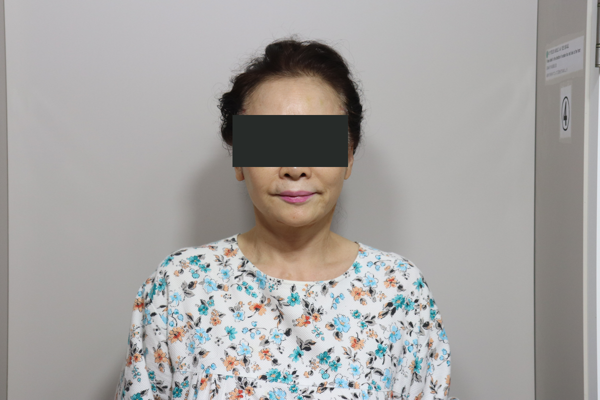 Eyelid surgery with facelift and neck lift at Good-Line Plastic Surgery. Suture-removal visit, frontal view. Good-Line case 02 after combined eyelid, facelift and neck lift procedures. The number of days after surgery was not supplied; eyes are covered for privacy.