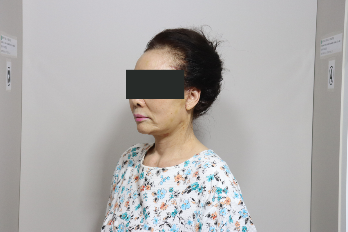 Eyelid surgery with facelift and neck lift at Good-Line Plastic Surgery. Suture-removal visit, oblique view facing left. Good-Line case 02 after combined eyelid, facelift and neck lift procedures. The number of days after surgery was not supplied; eyes are covered for privacy.