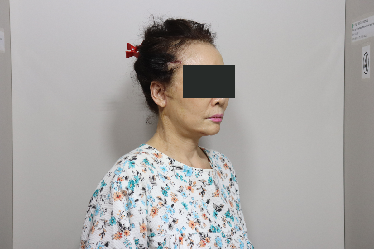 Eyelid surgery with facelift and neck lift at Good-Line Plastic Surgery. Suture-removal visit, oblique view facing right. Good-Line case 02 after combined eyelid, facelift and neck lift procedures. The number of days after surgery was not supplied; eyes are covered for privacy.