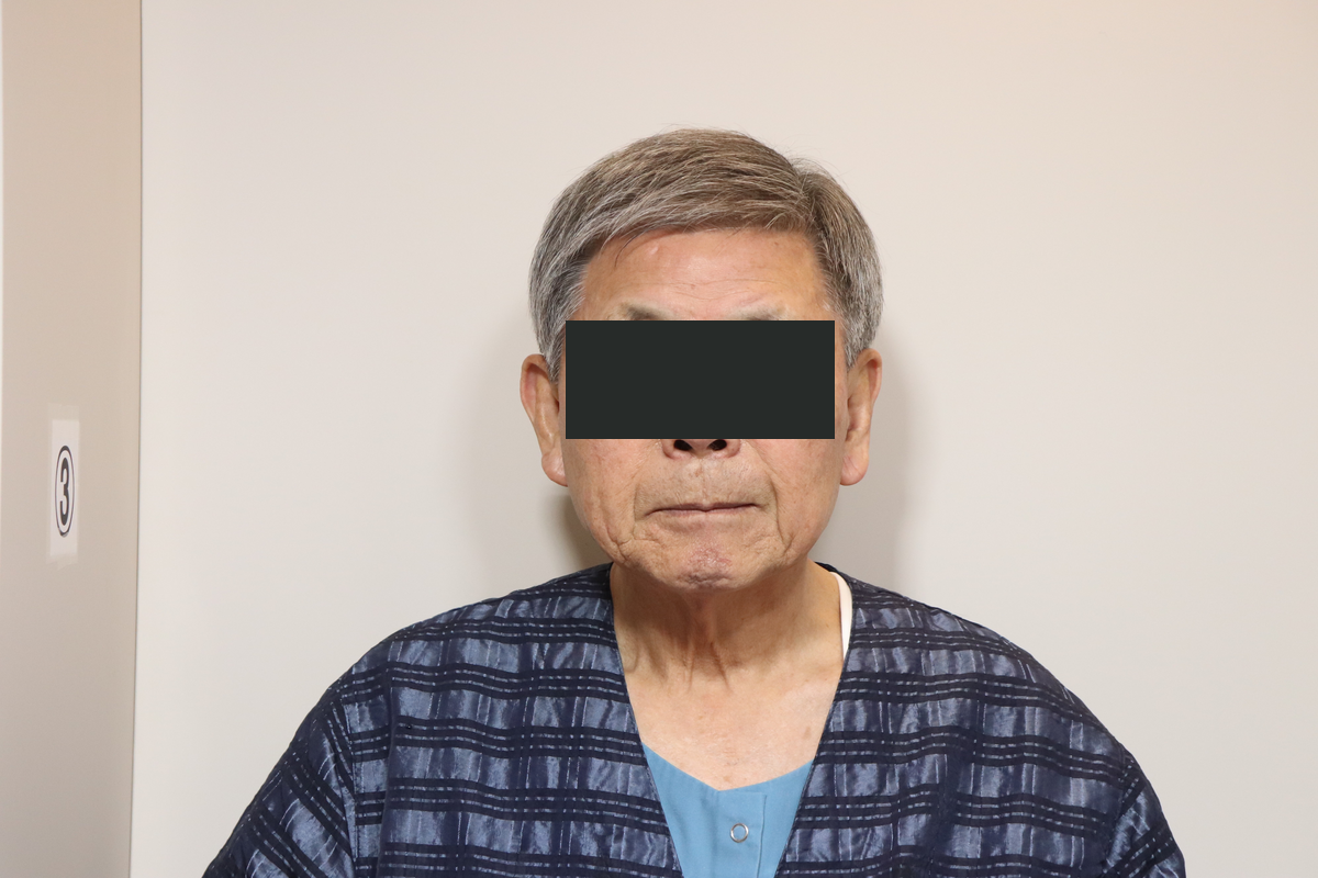 Male eyelid correction without a double crease and lower eyelid surgery at Good-Line Plastic Surgery. Before male eyelid surgery, frontal view — Good-Line case 03. Photograph dated 1 April 2025 in the accompanying reference card. Eyes are covered for privacy.