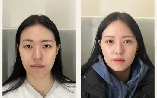 Revision eyelid and corner surgery — one month at Hani Plastic Surgery. Before on the left · 1 month after surgery on the right