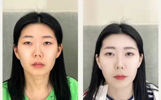 Revision eyelid and corner surgery — three months at Hani Plastic Surgery. Before on the left · 3 months after surgery on the right