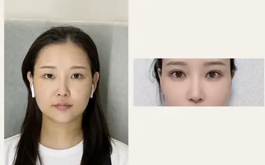 Eyelid revision and fat grafting — three-month close-up at Hani Plastic Surgery. Before on the left · 3 months after surgery on the right
