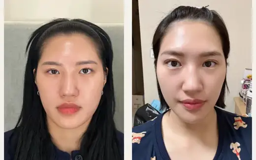 Revision eyelid crease — one-month follow-up at Hani Plastic Surgery. Before on the left · 1 month after surgery on the right