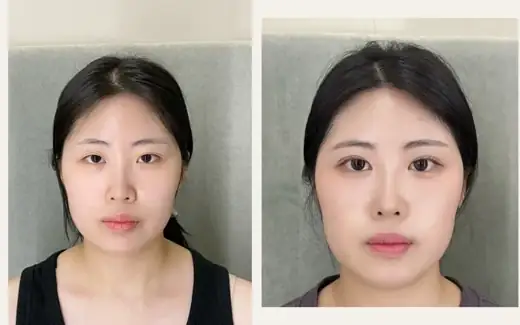 Eyelid revision and crease reinforcement — two months at Hani Plastic Surgery. Before on the left · 2 months after surgery on the right