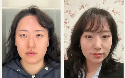 Revision eyelid surgery with fat grafting — three months at Hani Plastic Surgery. Before on the left · 3 months after surgery on the right