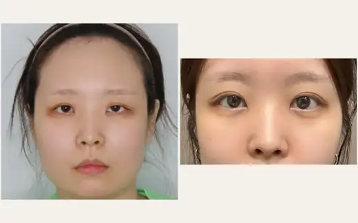 Revision eyelid surgery — one month with video at Hani Plastic Surgery. Before on the left · 1 month after surgery on the right