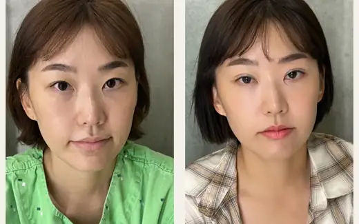 Revision double eyelid surgery — three weeks at Hani Plastic Surgery. Before on the left · 3 weeks after surgery on the right