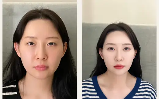 Revision eyelid surgery with fat grafting — one month at Hani Plastic Surgery. Before on the left · 1 month after surgery on the right