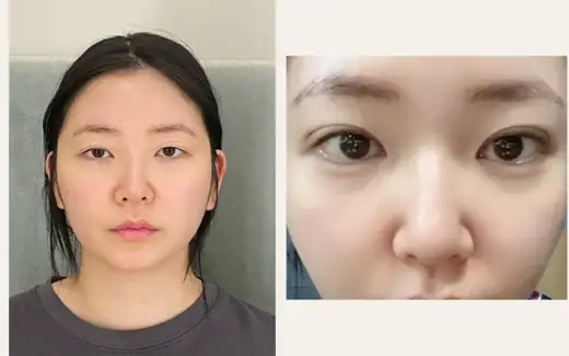 Revision eyelid surgery with fat grafting — early follow-up at Hani Plastic Surgery. Before on the left · 1 month after surgery on the right