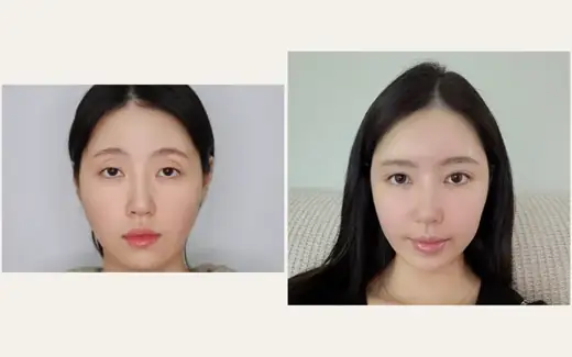 Revision eyelid surgery with left corner correction at Hani Plastic Surgery. Before on the left · 1 month after surgery on the right