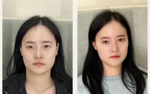 Revision eyelid and outer-corner surgery — one month at Hani Plastic Surgery. Before on the left · 1 month after surgery on the right