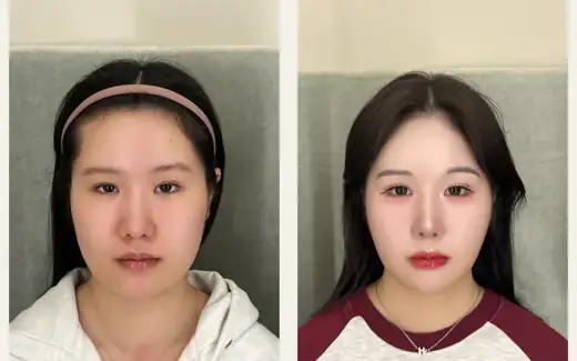 Revision eyelid surgery with right corner correction at Hani Plastic Surgery. Before on the left · 5 months after surgery on the right