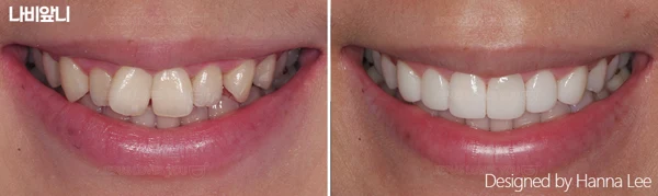 Angled front teeth: smile comparison at Harue Dental Clinic. Angled front teeth: smile comparison. Paired dental views in the clinic-supplied left-to-right order.