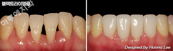 Black triangles: lower front-tooth comparison at Harue Dental Clinic. Black triangles: lower front-tooth comparison. Paired dental views in the clinic-supplied left-to-right order.