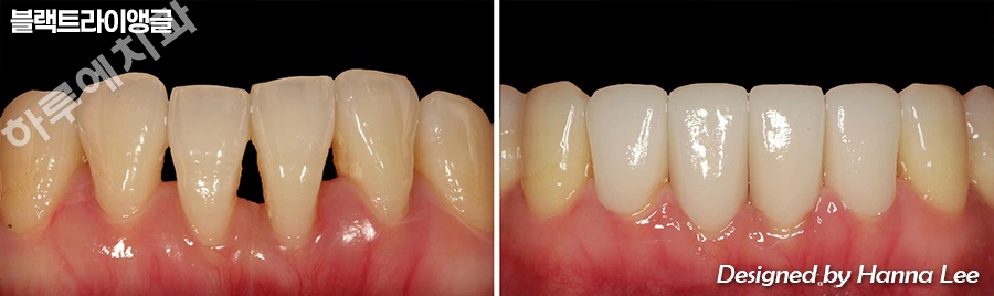 Black triangles: lower front-tooth comparison at Harue Dental Clinic. Black triangles: lower front-tooth comparison. Paired dental views in the clinic-supplied left-to-right order.