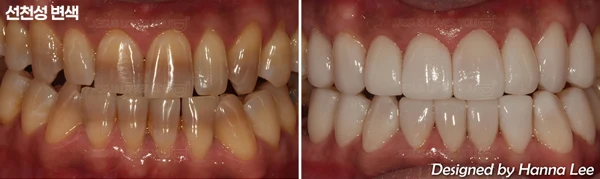 Tooth discolouration: upper and lower bite views at Harue Dental Clinic. Tooth discolouration: upper and lower bite views. Paired dental views in the clinic-supplied left-to-right order.