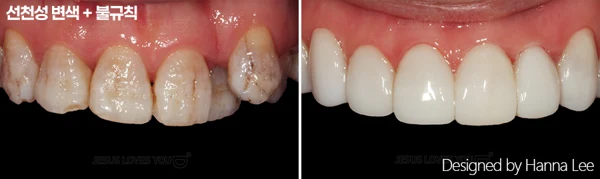 Discolouration and irregular front-tooth shape at Harue Dental Clinic. Discolouration and irregular front-tooth shape. Paired dental views in the clinic-supplied left-to-right order.