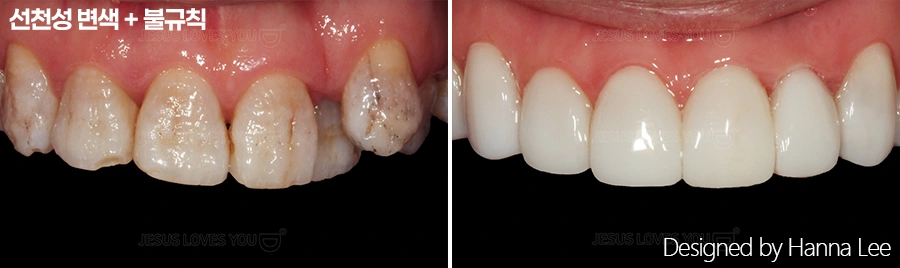 Discolouration and irregular front-tooth shape at Harue Dental Clinic. Discolouration and irregular front-tooth shape. Paired dental views in the clinic-supplied left-to-right order.