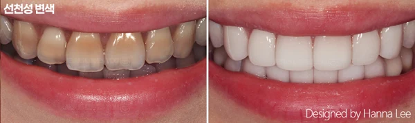 Tooth discolouration: full-smile comparison at Harue Dental Clinic. Tooth discolouration: full-smile comparison. Paired dental views in the clinic-supplied left-to-right order.