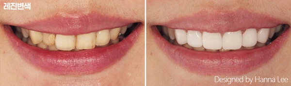 Discoloured resin: front-tooth comparison at Harue Dental Clinic. Discoloured resin: front-tooth comparison. Paired dental views in the clinic-supplied left-to-right order.
