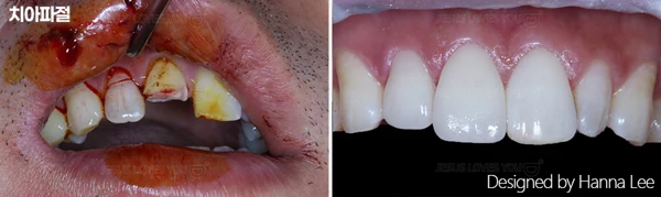 Fractured front teeth: clinical comparison at Harue Dental Clinic. Fractured front teeth: clinical comparison. Paired dental views in the clinic-supplied left-to-right order.