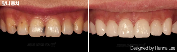 Front-tooth decay: clinical comparison at Harue Dental Clinic. Front-tooth decay: clinical comparison. Paired dental views in the clinic-supplied left-to-right order.