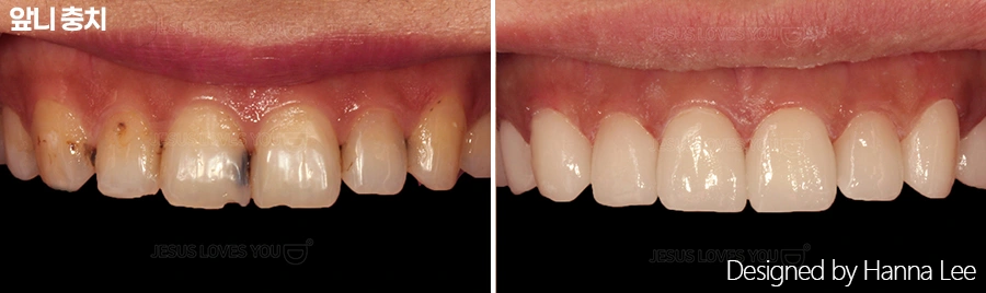Front-tooth decay: clinical comparison at Harue Dental Clinic. Front-tooth decay: clinical comparison. Paired dental views in the clinic-supplied left-to-right order.