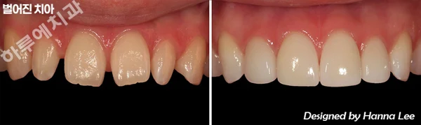 Gaps between front teeth: close-up comparison at Harue Dental Clinic. Gaps between front teeth: close-up comparison. Paired dental views in the clinic-supplied left-to-right order.