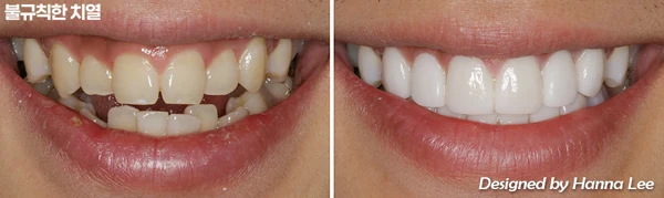 Irregular tooth positions: smile comparison at Harue Dental Clinic. Irregular tooth positions: smile comparison. Paired dental views in the clinic-supplied left-to-right order.