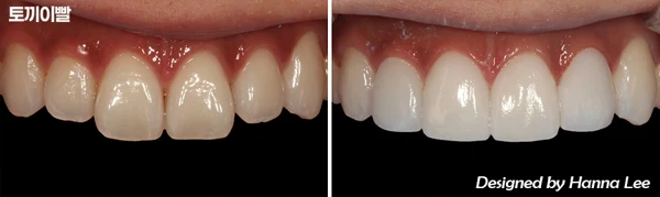 Long central incisors: tooth-proportion comparison at Harue Dental Clinic. Long central incisors: tooth-proportion comparison. Paired dental views in the clinic-supplied left-to-right order.
