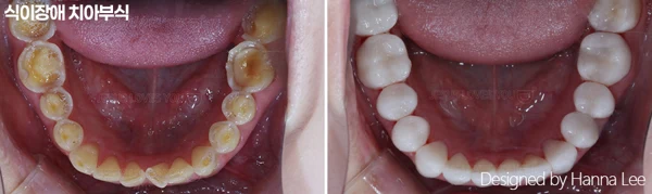 Lower-arch tooth wear: inside-mouth comparison at Harue Dental Clinic. Lower-arch tooth wear: inside-mouth comparison. Paired dental views in the clinic-supplied left-to-right order.