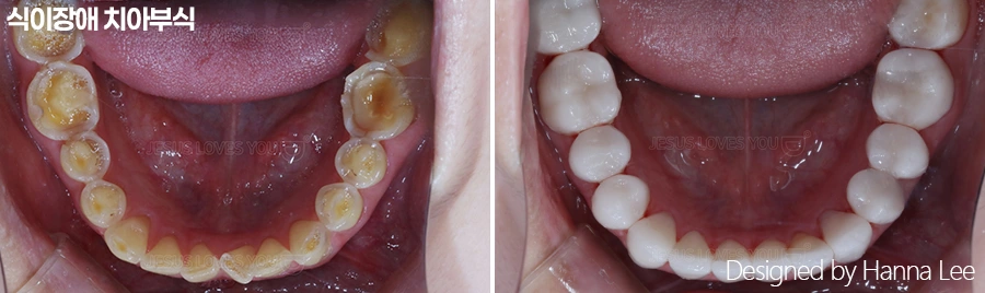 Lower-arch tooth wear: inside-mouth comparison at Harue Dental Clinic. Lower-arch tooth wear: inside-mouth comparison. Paired dental views in the clinic-supplied left-to-right order.