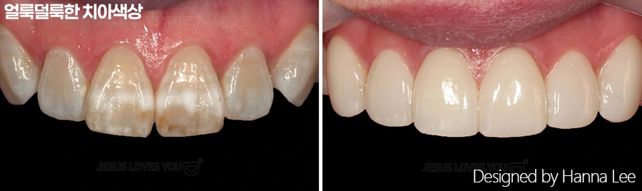 Mottled tooth colour: front-tooth close-ups at Harue Dental Clinic. Mottled tooth colour: front-tooth close-ups. Paired dental views in the clinic-supplied left-to-right order.