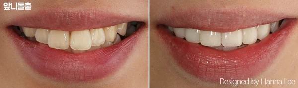 Prominent front teeth: smile comparison at Harue Dental Clinic. Prominent front teeth: smile comparison. Paired dental views in the clinic-supplied left-to-right order.