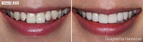 Rotated teeth: smile comparison at Harue Dental Clinic. Rotated teeth: smile comparison. Paired dental views in the clinic-supplied left-to-right order.