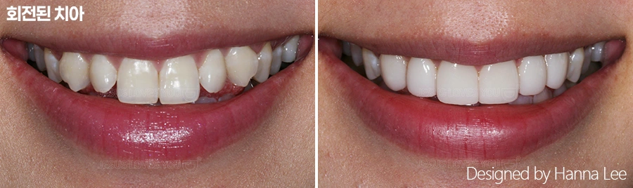 Rotated teeth: smile comparison at Harue Dental Clinic. Rotated teeth: smile comparison. Paired dental views in the clinic-supplied left-to-right order.