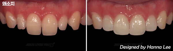 Small front teeth: before, treatment and after at Harue Dental Clinic. Small front teeth: before, treatment and after. Paired dental views in the clinic-supplied left-to-right order.