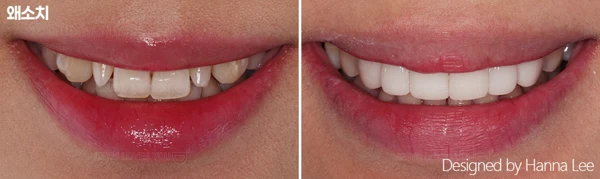 Small teeth: wider smile comparison at Harue Dental Clinic. Small teeth: wider smile comparison. Paired dental views in the clinic-supplied left-to-right order.