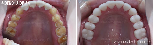 Upper-arch tooth wear: inside-mouth comparison at Harue Dental Clinic. Upper-arch tooth wear: inside-mouth comparison. Paired dental views in the clinic-supplied left-to-right order.