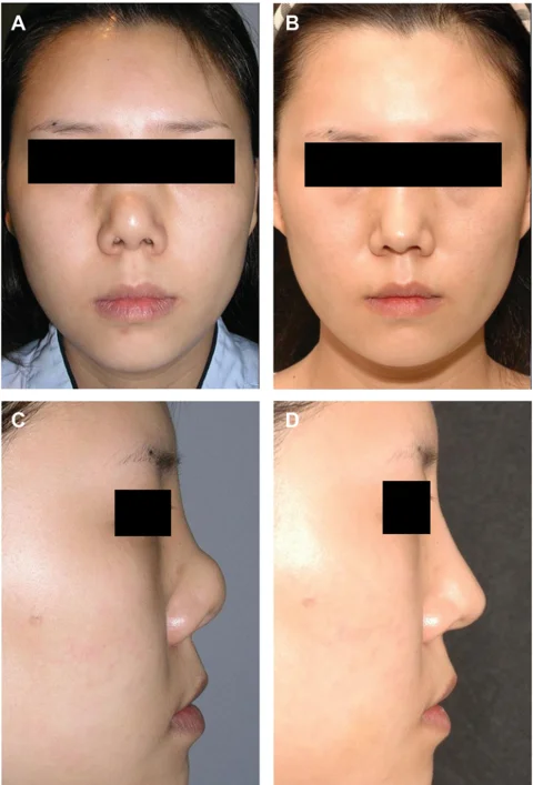 Contracted short-nose revision: 17 months at IBON Plastic Surgery. Figure 7 from Kim and colleagues (2012): front and profile views, before on the left and 17 months after surgery on the right. Eye regions are covered for privacy.