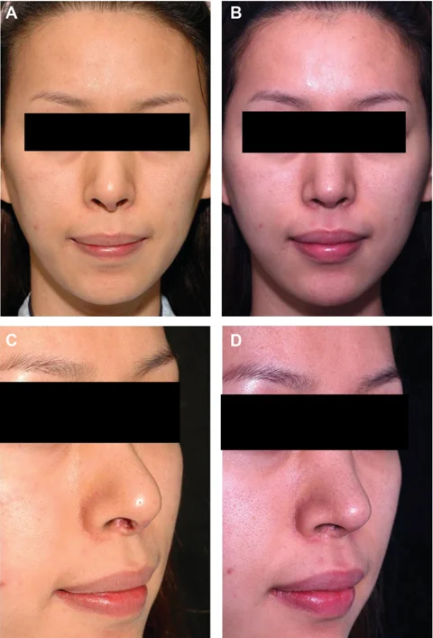 Revision rhinoplasty: supratip correction at 24 months at IBON Plastic Surgery. Figure 3 from Kim and colleagues (2012): front and angled views, before on the left and 24 months after surgery on the right. Eye regions are covered for privacy.