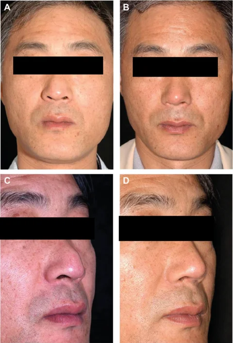 Primary pollybeak correction: 24-month views at IBON Plastic Surgery. Figure 4 from Kim and colleagues (2012): front and angled views, before on the left and 24 months after surgery on the right. Eye regions are covered for privacy.